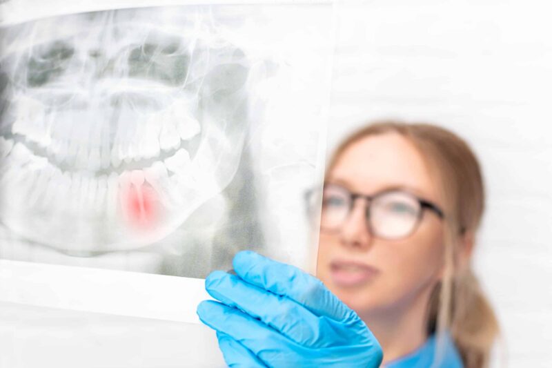 Tooth Extraction in Centennial